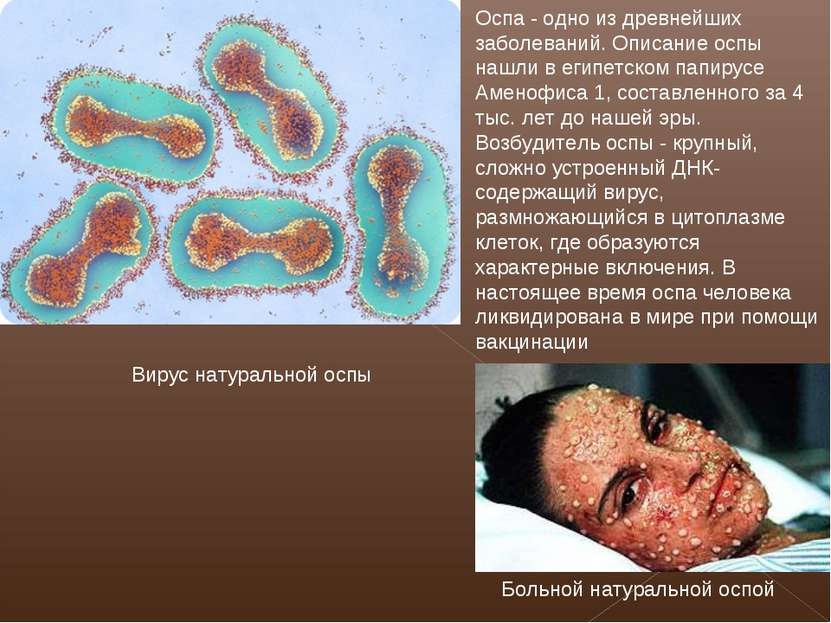Вирус натуральной оспы Больной натуральной оспой Оспа - одно из древнейших за...
