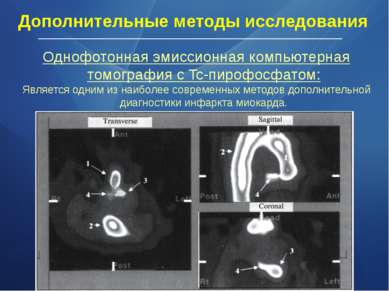 Однофотонная эмиссионная компьютерная томография с Tc-пирофосфатом: Является ...