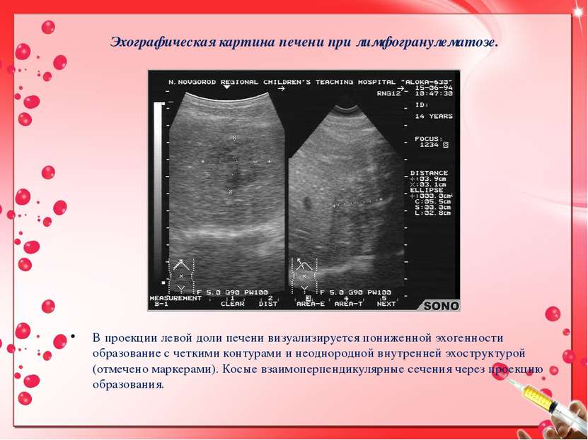 Эхографическая картина печени при лимфогранулематозе. В проекции левой доли п...