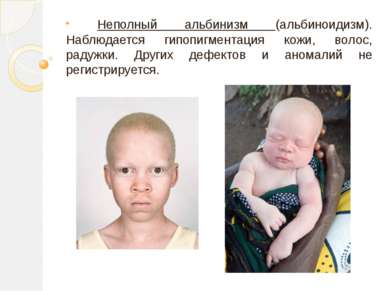 Неполный альбинизм (альбиноидизм). Наблюдается гипопигментация кожи, волос, р...