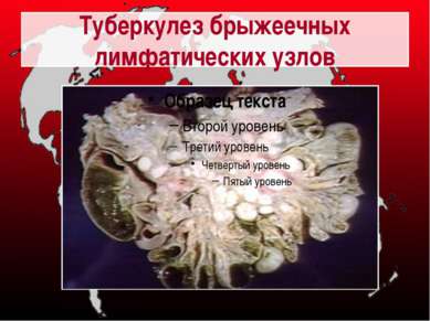 Туберкулез брыжеечных лимфатических узлов