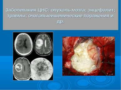 Заболевания ЦНС: опухоль мозга; энцефалит; травмы; очаговыеишемические пораже...