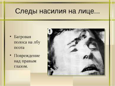 Следы насилия на лице... Багровая полоса на лбу поэта Повреждение над правым ...