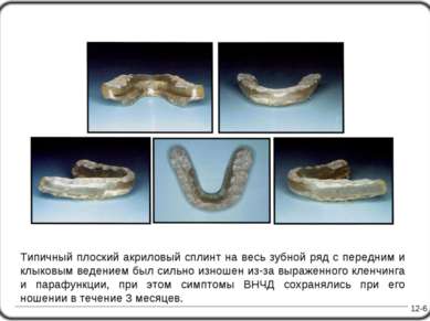 12-6 Типичный плоский акриловый сплинт на весь зубной ряд с передним и клыков...