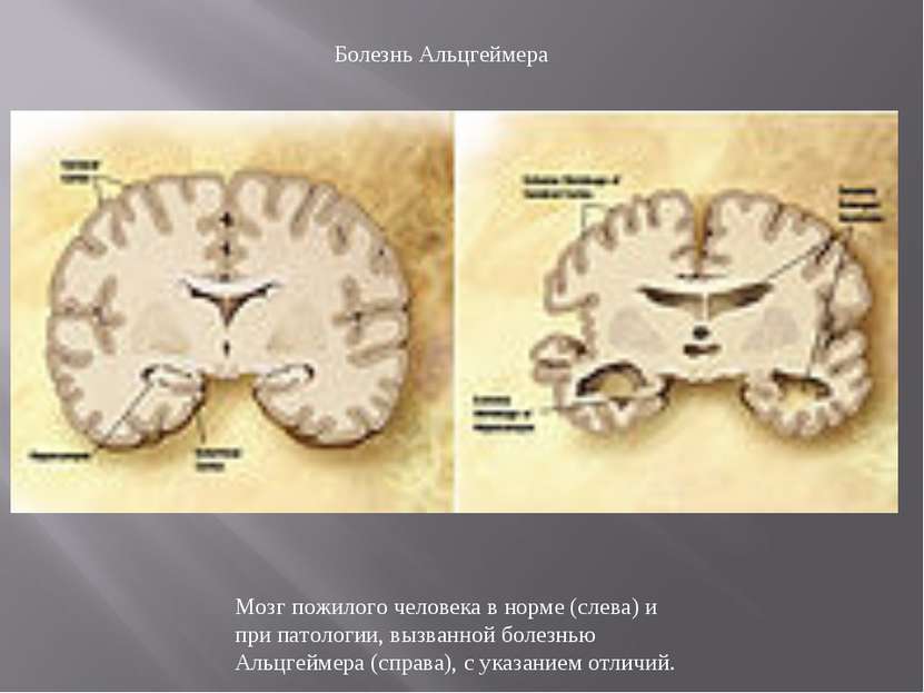 Мозг пожилого человека в норме (слева) и при патологии, вызванной болезнью Ал...