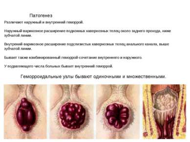 Патогенез Различают наружный и внутренний геморрой. Наружный-варикозное расши...