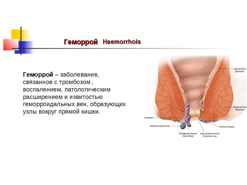 Геморрой Haemorrhois Геморрой – заболевание, связанное с тромбозом , воспален...