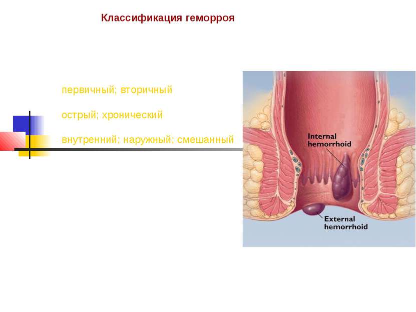 Классификация геморроя первичный; вторичный острый; хронический внутренний; н...