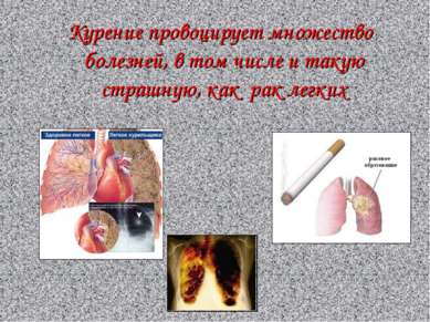 Курение провоцирует множество болезней, в том числе и такую страшную, как рак...