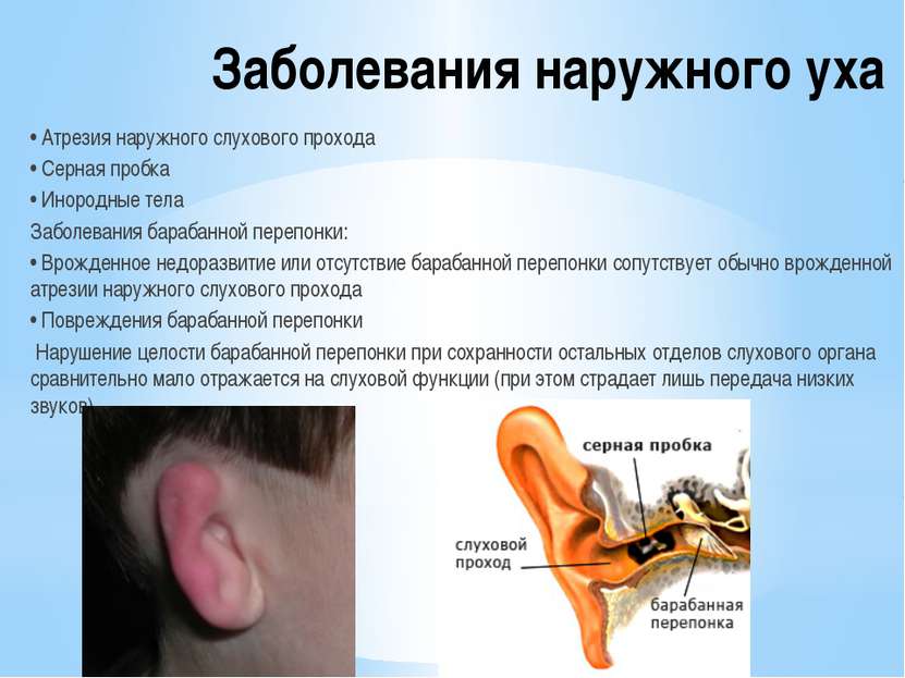Заболевания наружного уха • Атрезия наружного слухового прохода • Серная проб...