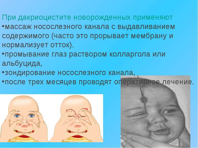 При дакриоцистите новорожденных применяют массаж носослезного канала с выдавл...