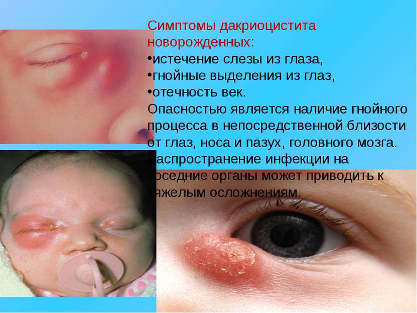 Симптомы дакриоцистита новорожденных: истечение слезы из глаза, гнойные выдел...