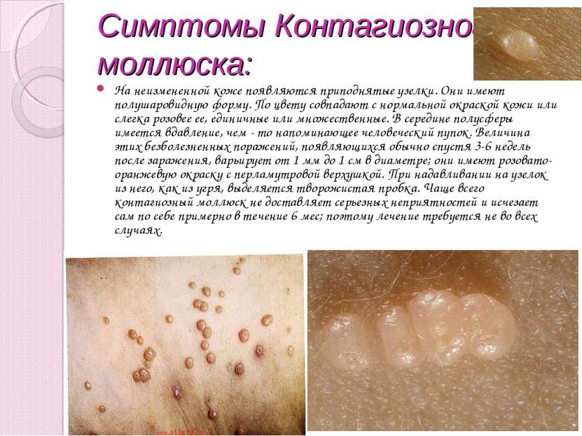 Симптомы Контагиозного моллюска: На неизмененной коже появляются приподнятые ...