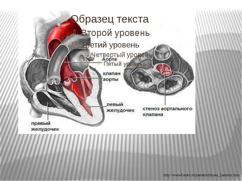 http://www.kardio.ru/patients/illness_2astenoz.htm