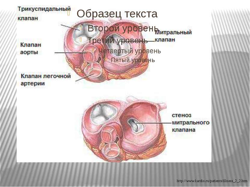 http://www.kardio.ru/patients/illness_2_2.htm
