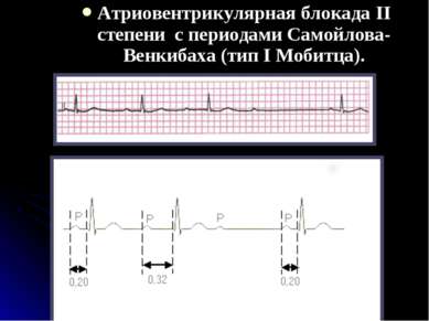 Атриовентрикулярная блокада II степени с периодами Самойлова-Венкибаха (тип I...
