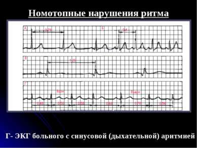 Номотопные нарушения ритма Г- ЭКГ больного с синусовой (дыхательной) аритмией