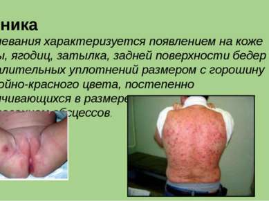 Клиника  заболевания характеризуется появлением на коже спины, ягодиц, затылк...