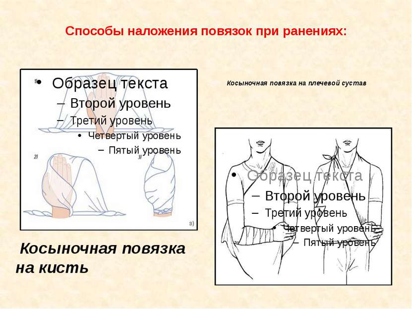 Способы наложения повязок при ранениях: Косыночная повязка на кисть Косыночна...