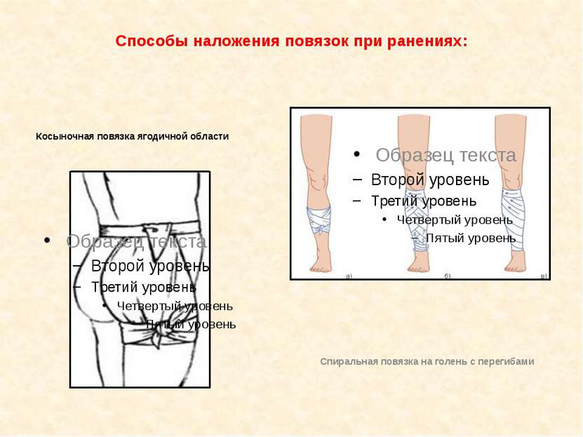 Способы наложения повязок при ранениях: Косыночная повязка ягодичной области ...