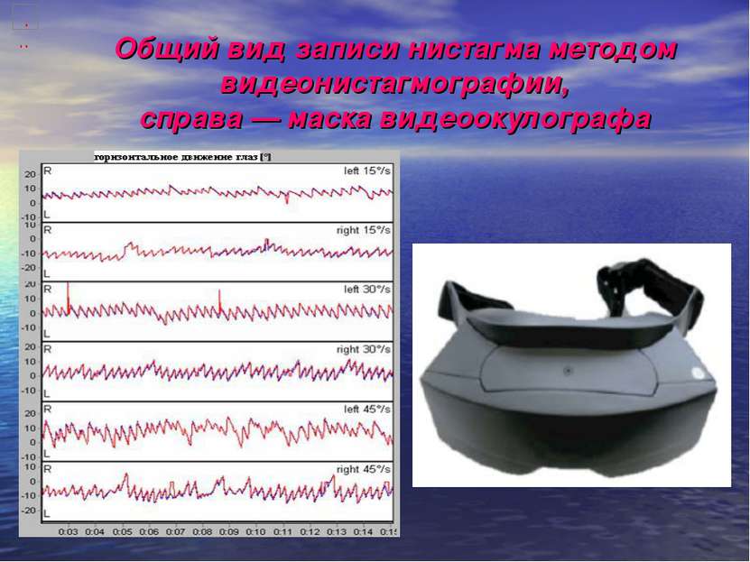Общий вид записи нистагма методом видеонистагмографии, справа — маска видеоок...