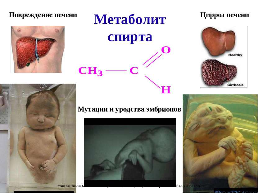 Метаболит спирта Повреждение печени Цирроз печени Мутации и уродства эмбрионо...