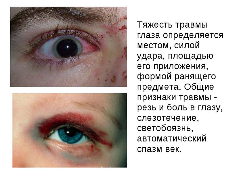 Тяжесть травмы глаза определяется местом, силой удара, площадью его приложени...