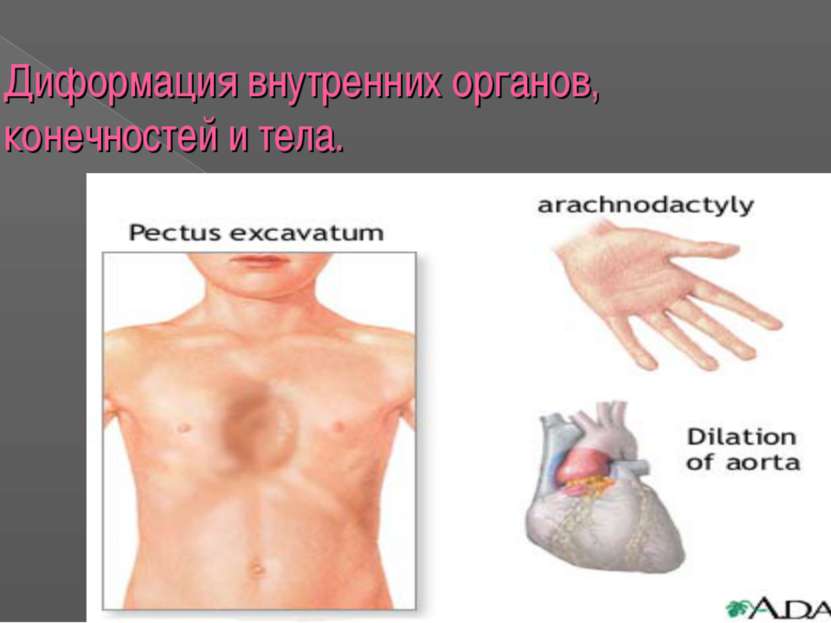 Диформация внутренних органов, конечностей и тела.