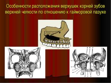 Особенности расположения верхушек корней зубов верхней челюсти по отношению к...