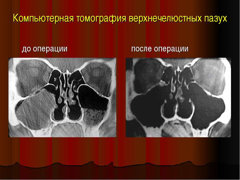 Компьютерная томография верхнечелюстных пазух до операции после операции