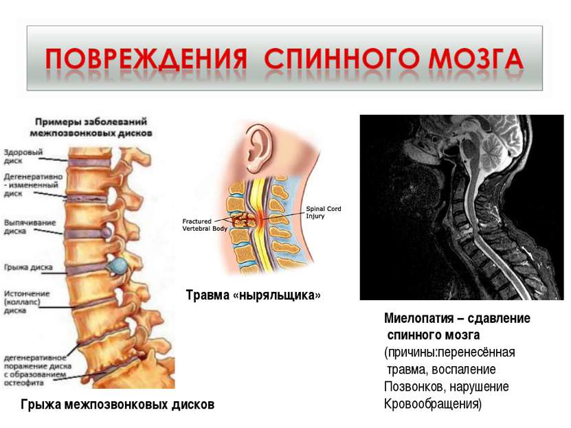 Травма «ныряльщика» Миелопатия – сдавление спинного мозга (причины:перенесённ...