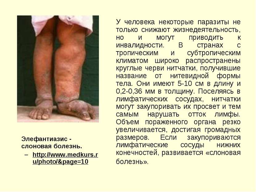 Элефантиазис - cлоновая болезнь. http://www.medkurs.ru/photo/&page=10 У челов...