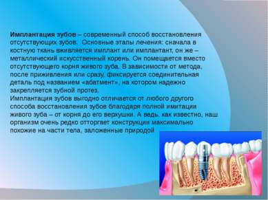 Имплантация зубов – современный способ восстановления отсутствующих зубов.  О...