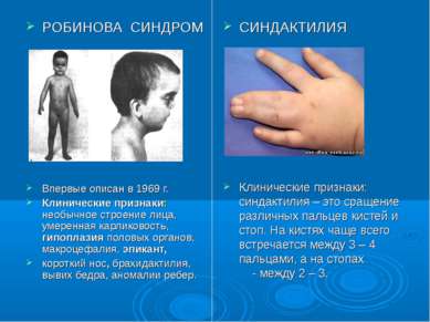 СИНДАКТИЛИЯ Клинические признаки: синдактилия – это сращение различных пальце...