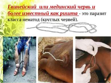 Гвинейский или мединский червь и более известный как ришта - это паразит клас...