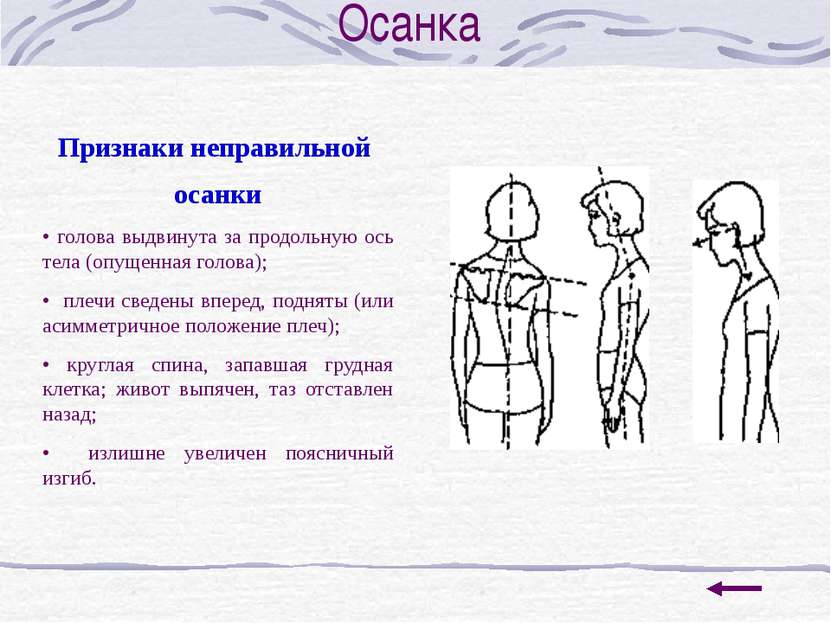 Осанка Признаки неправильной осанки • голова выдвинута за продольную ось тела...