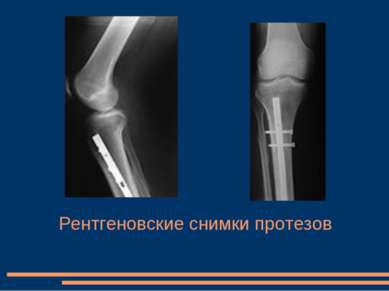 Рентгеновские снимки протезов