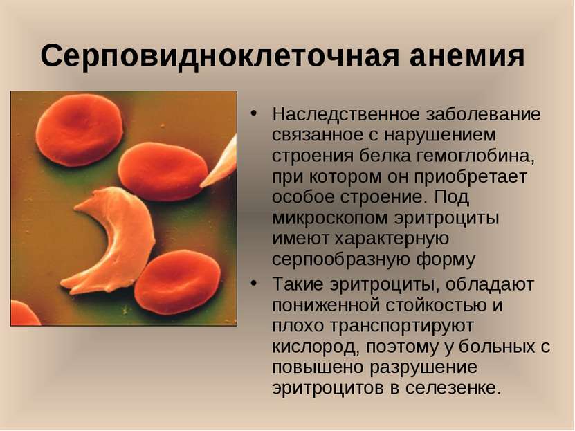 Серповидноклеточная анемия Наследственное заболевание связанное с нарушением ...