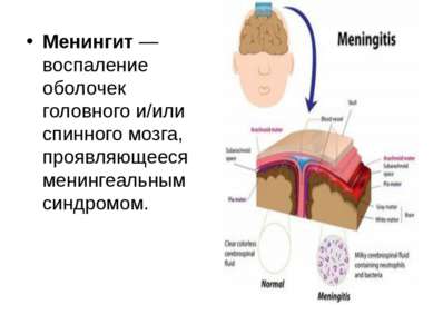Менингит — воспаление оболочек головного и/или спинного мозга, проявляющееся ...