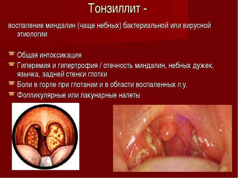 Тонзиллит - воспаление миндалин (чаще небных) бактериальной или вирусной этио...