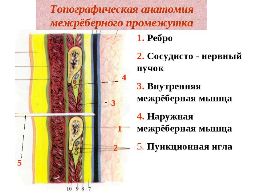Топографическая анатомия межрёберного промежутка 1. Ребро 2. Сосудисто - нерв...