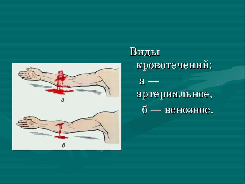 Виды кровотечений: а — артериальное, б — венозное.