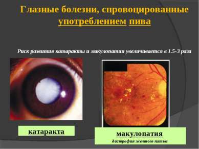 Глазные болезни, спровоцированные употреблением пива Риск развития катаракты ...
