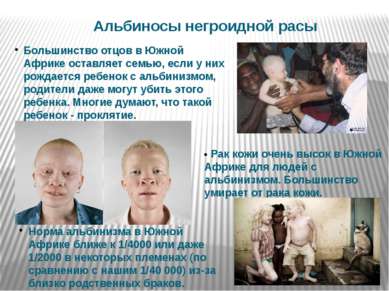 • Рак кожи очень высок в Южной Африке для людей с альбинизмом. Большинство ум...