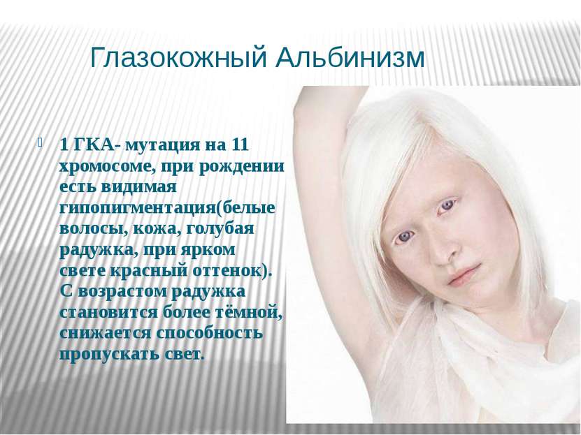 Глазокожный Альбинизм 1 ГКА- мутация на 11 хромосоме, при рождении есть видим...