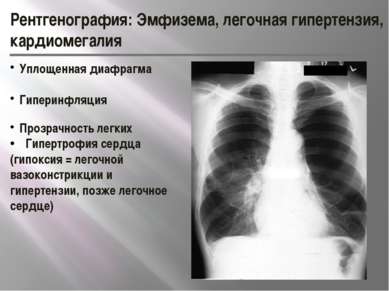 Рентгенография: Эмфизема, легочная гипертензия, кардиомегалия Уплощенная диаф...