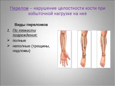 Перелом – нарушение целостности кости при избыточной нагрузке на нее Виды пер...
