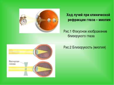 Ход лучей при клинической рефракции глаза – миопия Рис.1 Фокусное изображение...