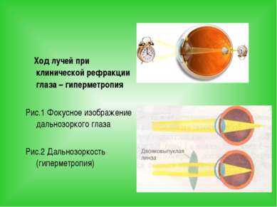 Ход лучей при клинической рефракции глаза – гиперметропия Рис.1 Фокусное изоб...
