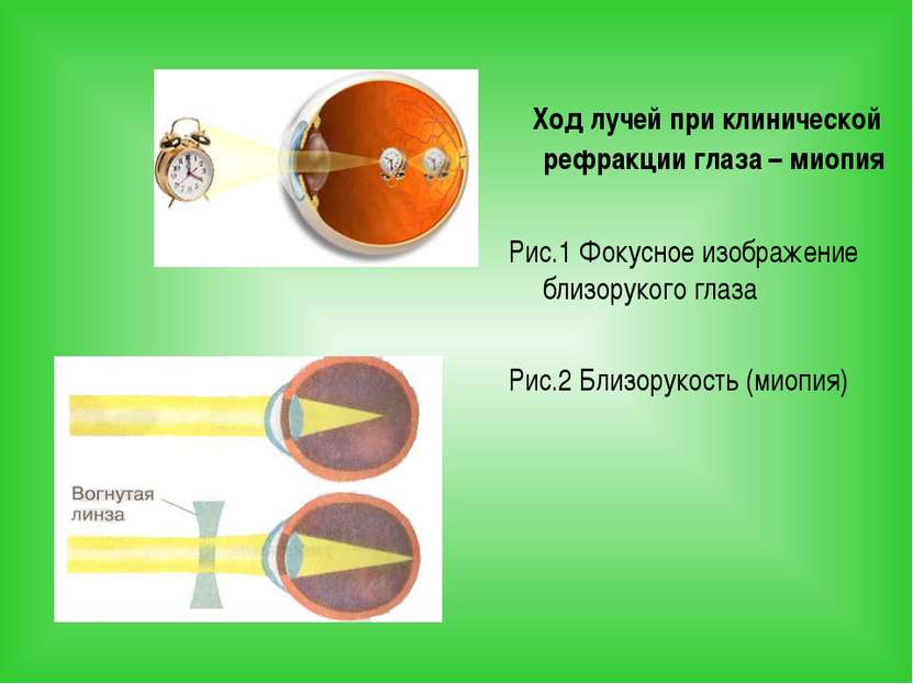 Ход лучей при клинической рефракции глаза – миопия Рис.1 Фокусное изображение...